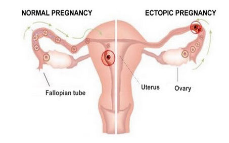 Ectopic Pregnancy