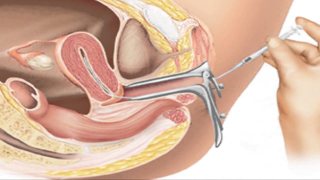 Intrauterine Insemination | Best Infertility Doctors in Trivandrum