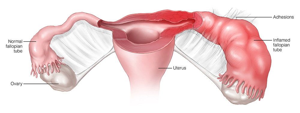 Tubo Ovarian Abscess Best Gynaecology And Maternity Hospital Trivandrum
