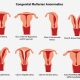 Congenital-Uterine-Abnormalities