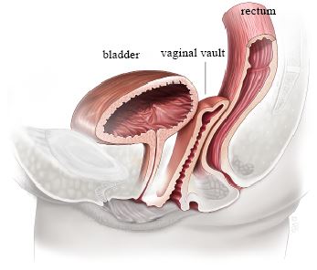 Vaginal_Hysterectomy