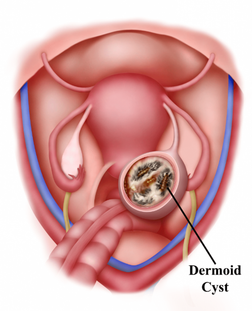 Ovarian Dermoid Cysts | Ovarian Teratomas | KJK Hospital, Trivandrum