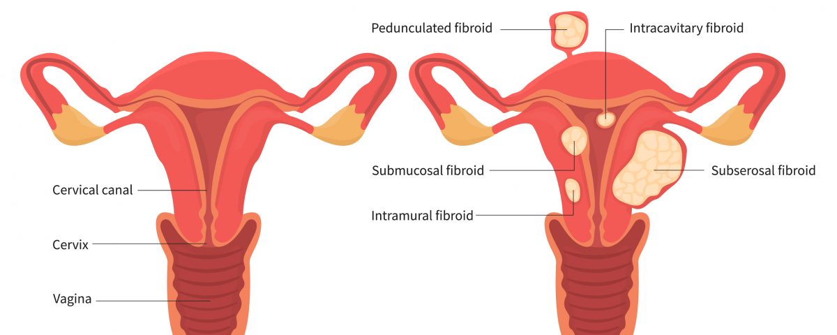 facts about fibroids