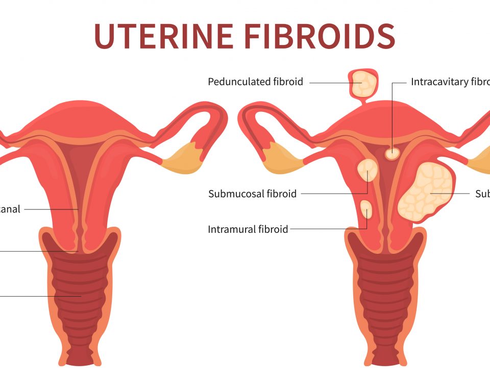facts about fibroids